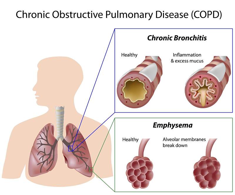COPD Causes, Symptoms, Tests, Treatment, Prevention