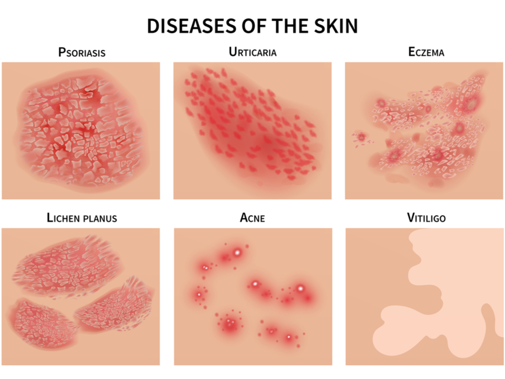 Skin Disorders, Types and Solutions