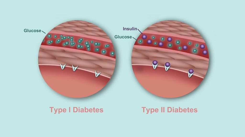 What is Type 2 Diabetes? Its Causes, Symptoms and Treatment