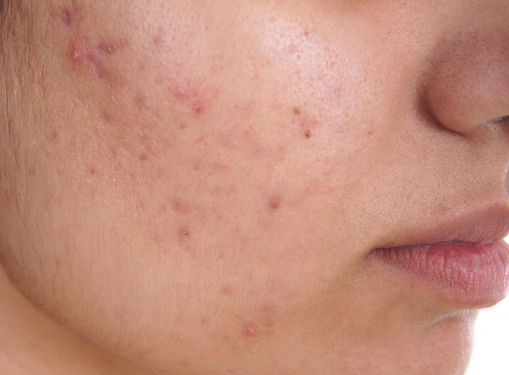 Acne The What Why And How