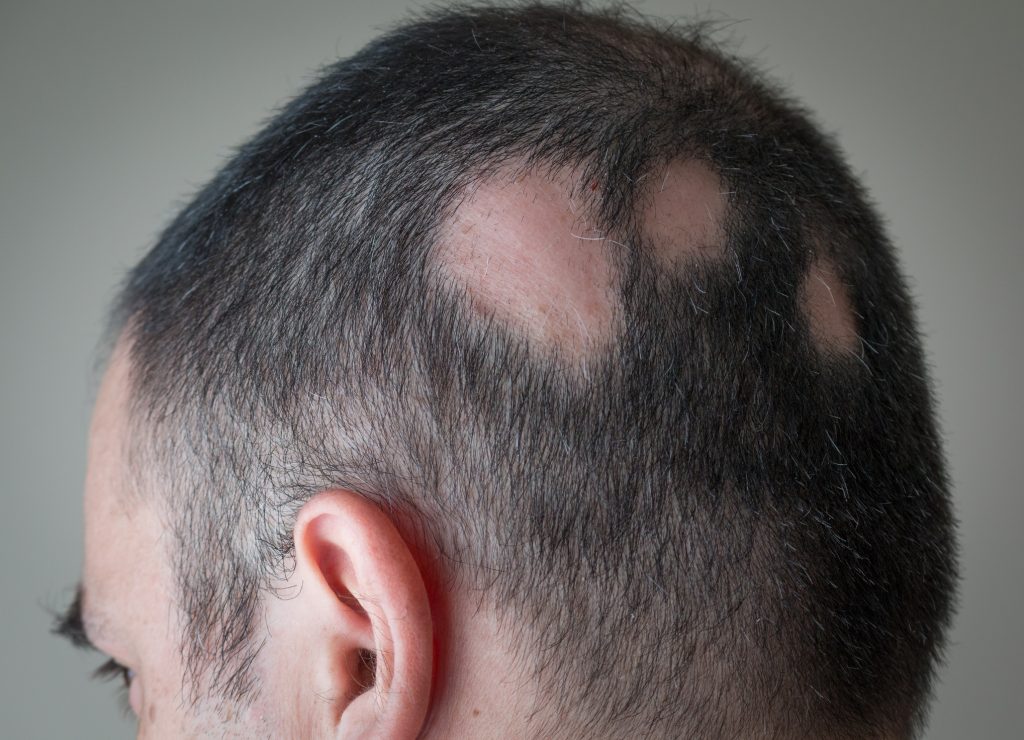 Causes Of Hair Loss, Types and Treatment