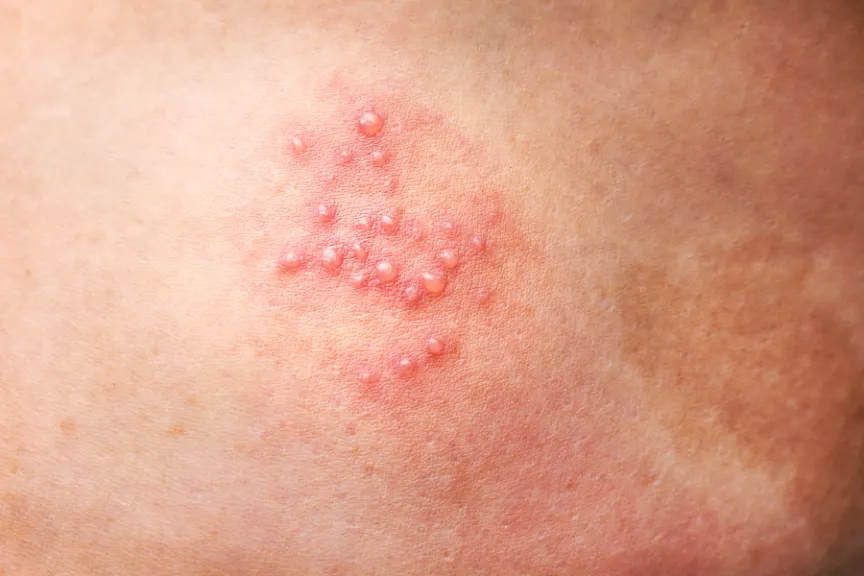 Causes of Shingles, Symptoms, and Treatment