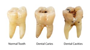 Cavities: Signs, Diagnosis and Treatment