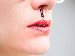 Common Causes As Well As Treatment Methods For Nosebleed