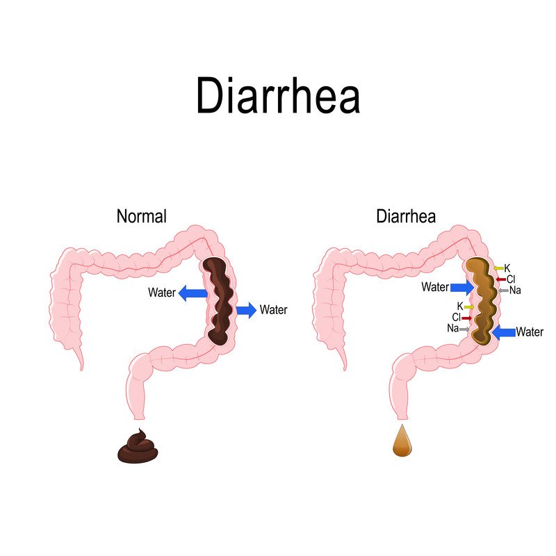 Diarrhea – Causes, Symptoms and Treatment
