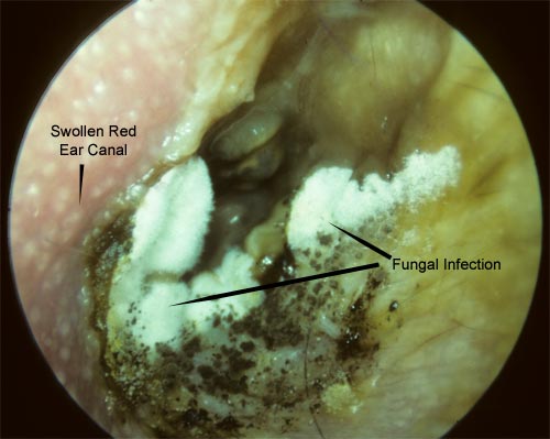 Ear Fungus As a Type of Fungal Infection