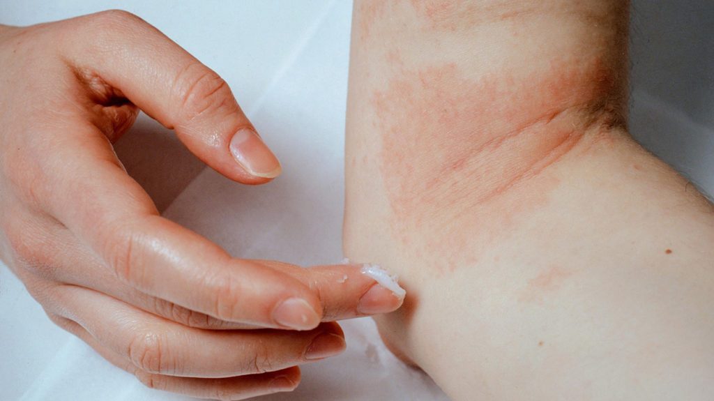 Eczema Causes and Eczema Treatment