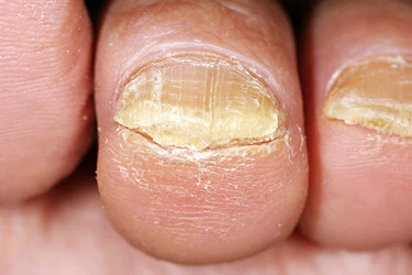 Fungal Nail Infection Causes, Symptoms and How to Treat Toenail Fungus