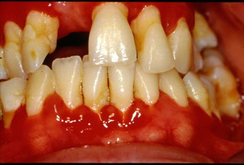 Gingivitis Symptoms, Causes and Treatment