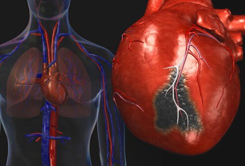 Heart Disease Symptoms and Treatment