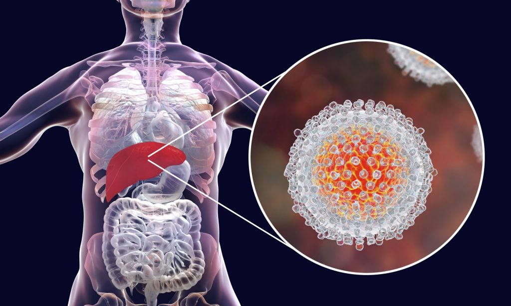 Hepatitis C Symptoms and Complications