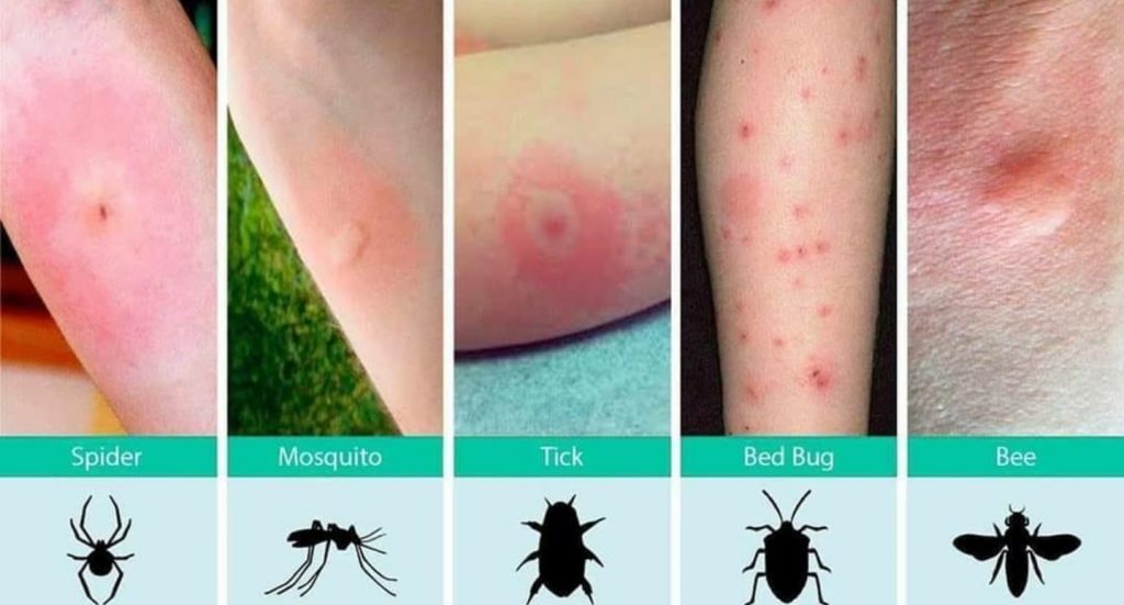 How To Tell The Difference Between Bug Bites