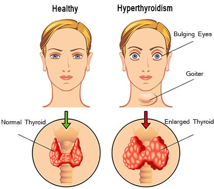 Hyperthyroidism - Symptoms, Treatment, Causes and Diagnosis