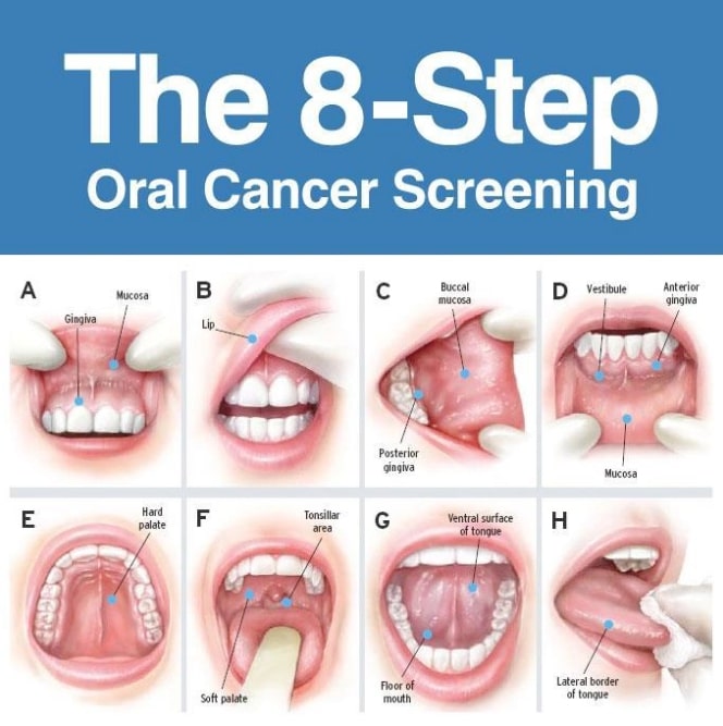 Oral Cancer Symptoms, Early Signs, First Warning Signs of Mouth Cancer