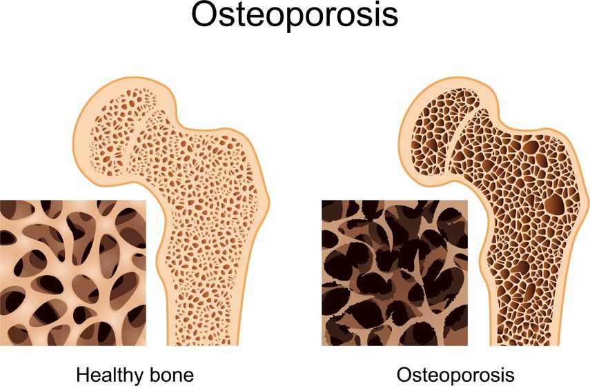 Osteoporosis Causes and Symptoms and Alternative Treatment of Osteoporosis