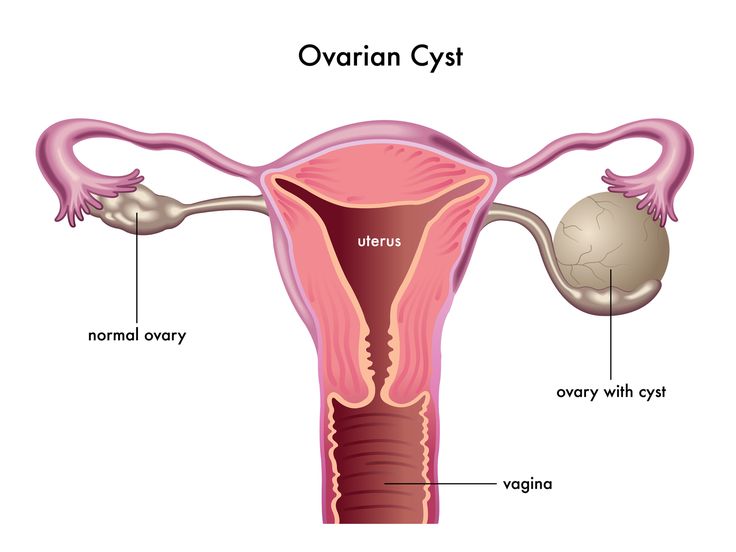 Ovarian Cysts - Symptoms, Causes and Treatments