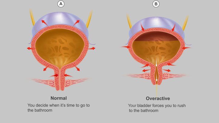 Overactive Bladder, Symptoms, and Diagnoses