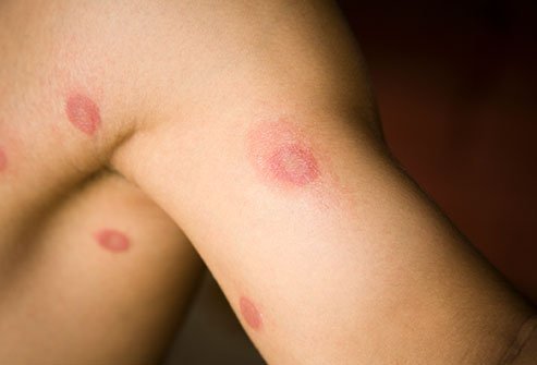 Overview of Different Fungal Skin Infections
