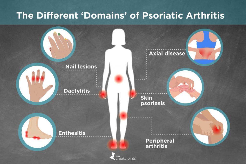 Psoriatic Arthritis Symptoms and Causes