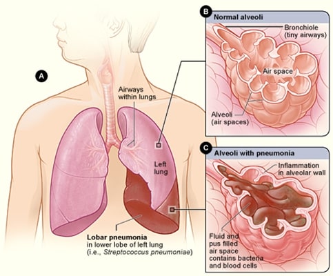 Symptoms of Pneumonia in Infants, Children, and Adults