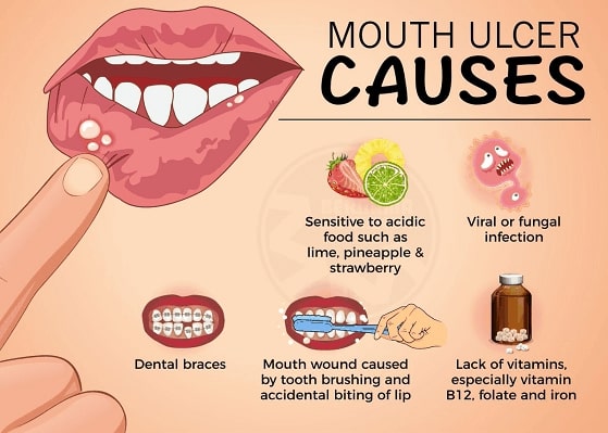 What Are Mouth Ulcers and Causes