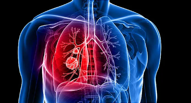 What Are The Stages Of Lung Cancer?