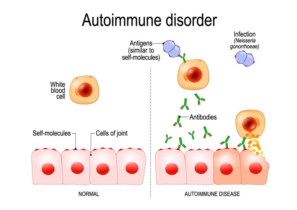 What Causes Autoimmune Diseases?