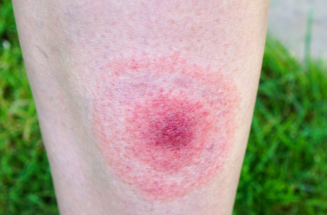 What Is Lyme Disease and Prognosis