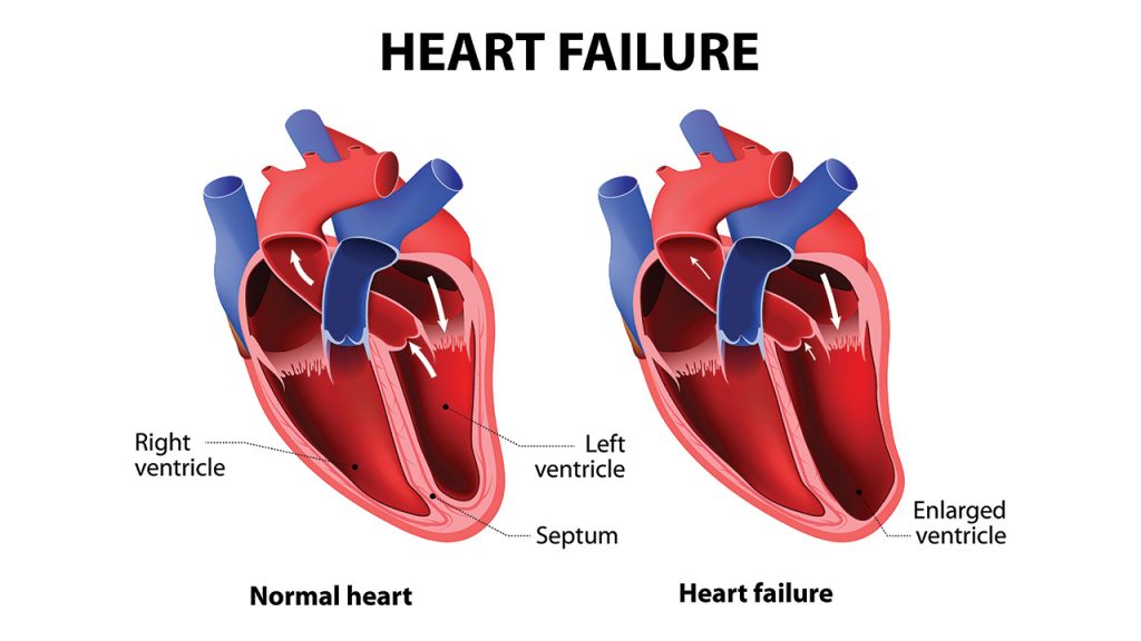 What is Congestive Heart Failure?