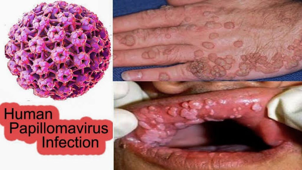 What is Human Papillomavirus Infection?