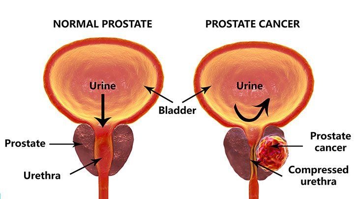 What is Prostate Cancer
