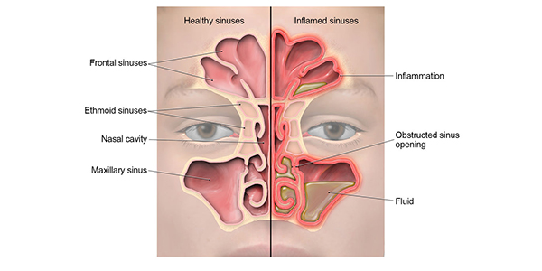 What is Sinusitis and its Causes