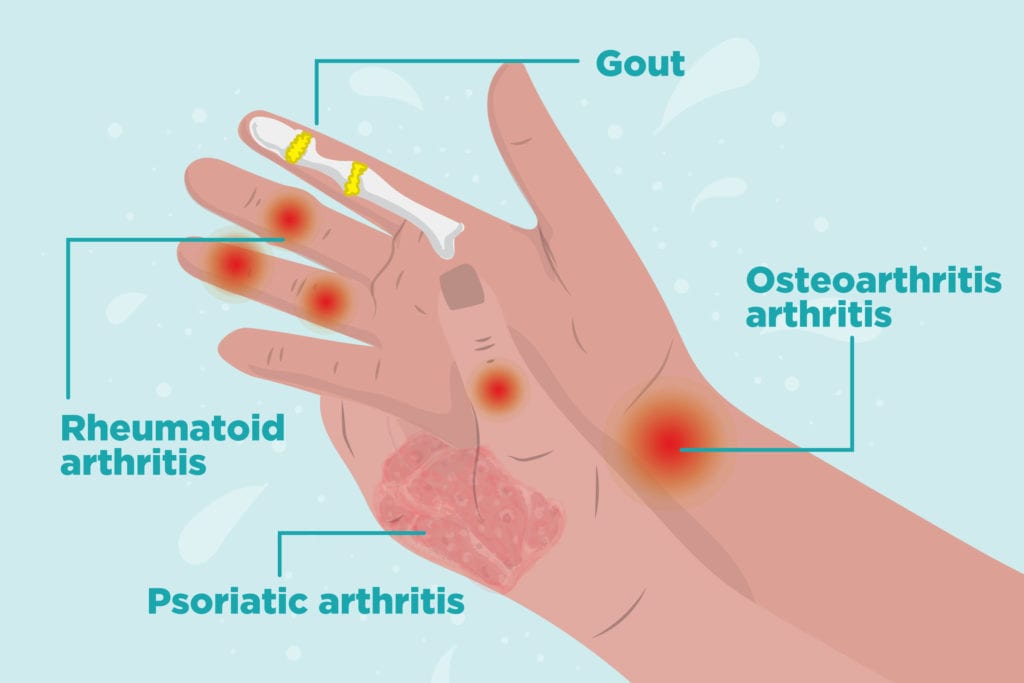 You Can Live With Arthritis Pain